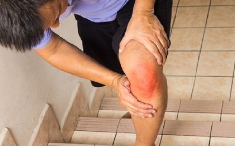 Knieschmerzen durch Arthritis