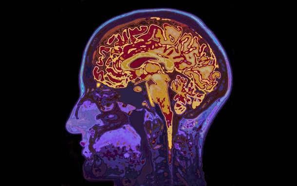 Gehirn in MRT Scan