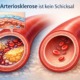 Illustration einer verengten Arterie mit Plaqueablagerungen im Vergleich zu einer gesunden Arterie bei Arteriosklerose